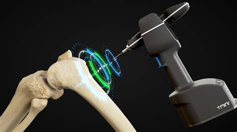 Think Surgical S TMINI System Gets FDA Clearance