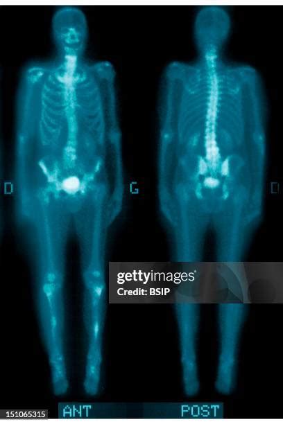 Scoliosis Photos And Premium High Res Pictures Getty Images