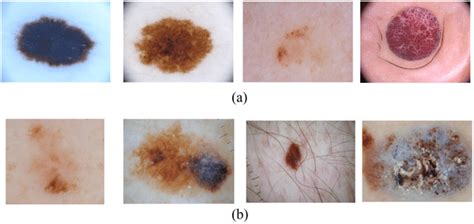 Selected Images Of A Benign And B Malignant Skin Cancer From Isic