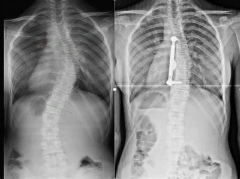 Chirurgie De La Scoliose Turquie Prix And Cliniques