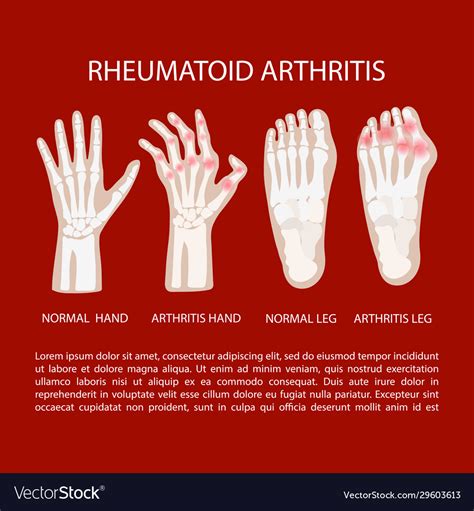 Arthritis leg hand rheumatoid medicine education v