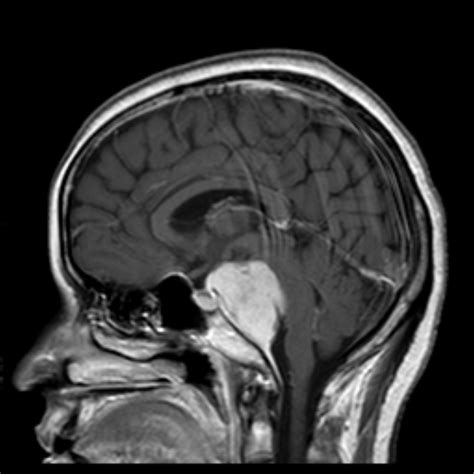 Clival Meningioma Image