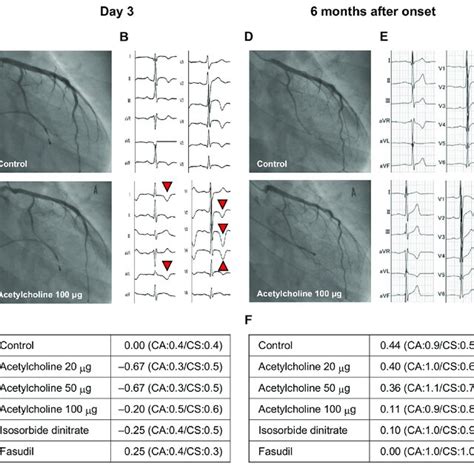 Histopathological Findings Of Myocardial Biopsy With Hematoxylin Eosin