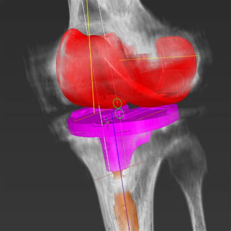 Orthopedic Software Medicad Hectec Gmbh Planning Knee 3d