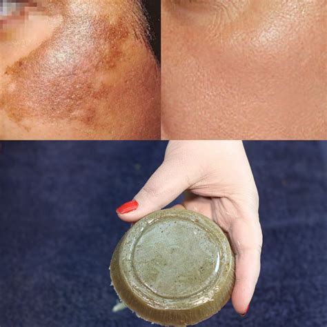 How To Remove Dark Spots On Skin Hyper Pigmentation Darkness Around