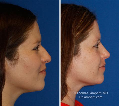 Hanging Columella Rhinoplasty In Seattle Rhinoplasty Surgeon