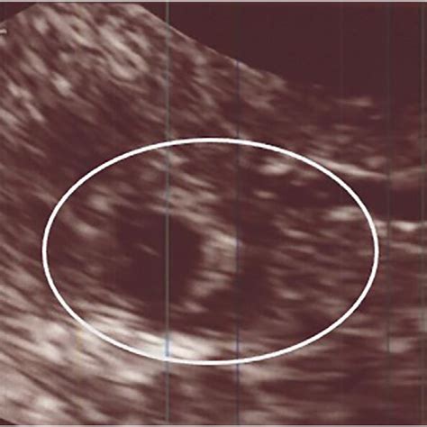 Findings Of The Transvaginal Ultrasonography Transvaginal