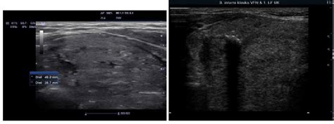 The Role Of Ultrasound In The Differential Diagnosis Of Hypothyroidism