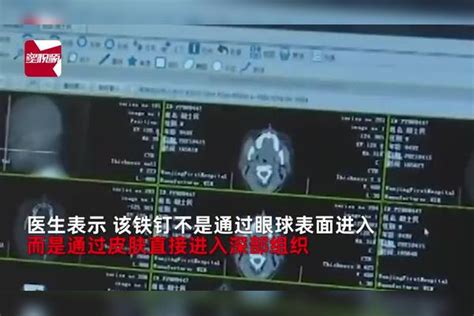 男子铁钉扎入眼眶，整整三天没发现，医生妙手取出保住眼球