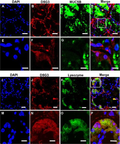 Immunofluorescent Double Labeling Of DSG3 And MUC5B Or Lysozyme In