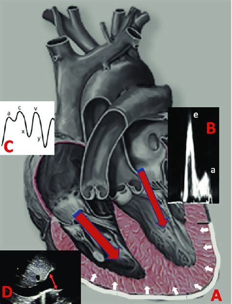 Constrictive Pericarditis Physiology During Early To Mid Diastole Download Scientific Diagram