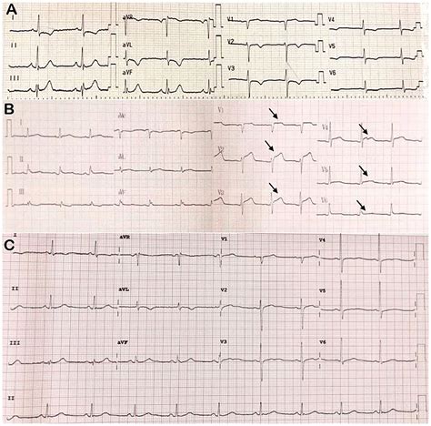 Cardiac Tamponade Ecg