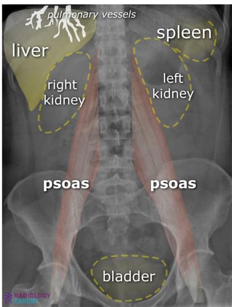 Psoas Sign X Ray