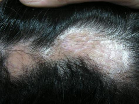 Hair Diseases Alopecia Cicatricial Picture Hellenic Dermatological