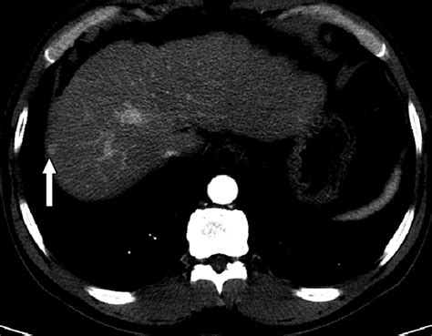 Percutaneous Radiofrequency Ablation With Artificial Ascites For