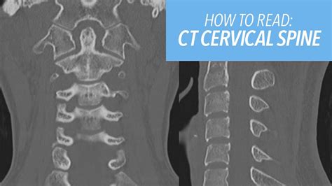 How To Read A Ct Of The Cervical Spine Youtube