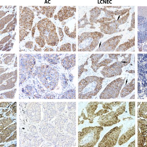 Immunohistochemistry Of E Cadherin β Catenin And N Cadherin Protein Download Scientific