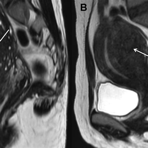 Sagittal T Weighted Mr Images Show A Focal Adenomyosis On The