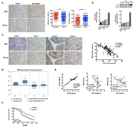 Inverse Expression Of Rip And Mdsc Markers In Hcc Correlates With Poor