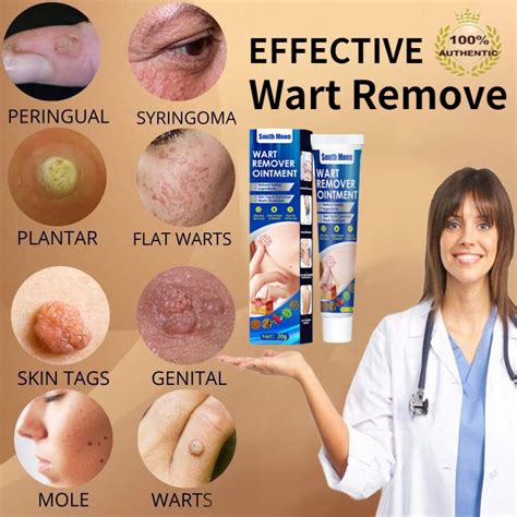 South Moon Warts Remover Original Cream Warts Magic Remover Wartz ...