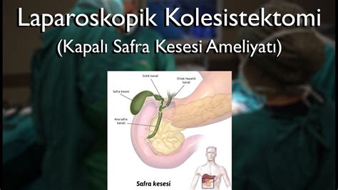 Laparoskopik Kolesistektomi Kapalı Safra Kesesi Ameliyatı Op Dr