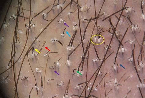 Trichoscopy Of Tinea Capitis With Polimorphic Pattern Including Bent Download Scientific