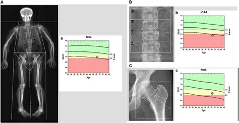 Absorciometría de rayos X de energía dual DEXA