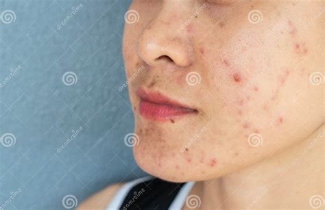 Close Up Of Woman Half Face With Problems Of Acne Inflammation Papule