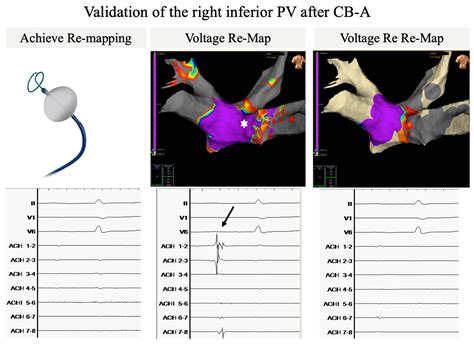 JCDD Free Full Text Adding Electroanatomical Mapping To Cryoballoon