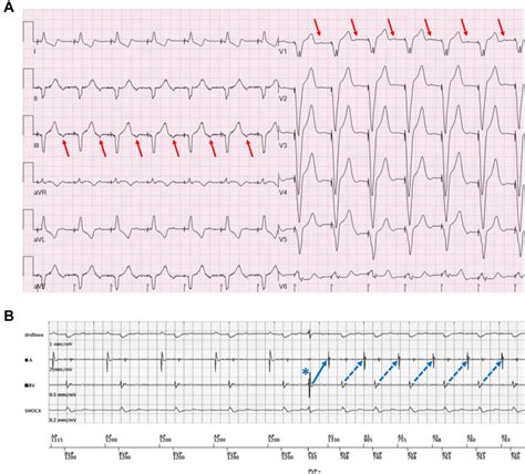 long  longer retrograde conduction    solution abstract