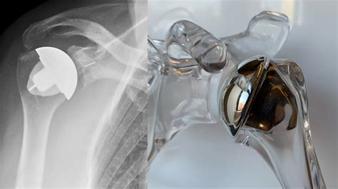 Total Shoulder Replacement Anatomic And Reverse Hss Shoulder