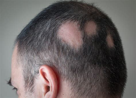 Alopecia Androg Nica S Ntomas Causas Y Tratamiento Mejor Con Salud