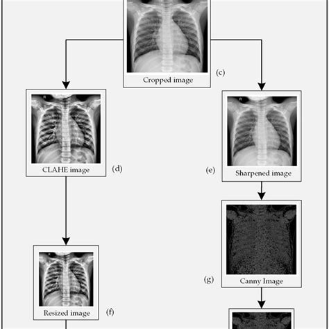 Methodology Of The Proposed Automatic Pneumonia Diagnosis Model