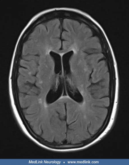 Susac Syndrome Medlink Neurology