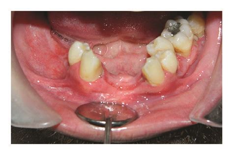 A Intraoral View Of The Patient Months After Initiation Of