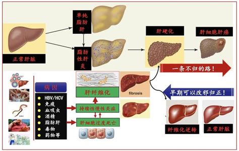 认清肝硬化进展规律，做好自我健康管理 微医（挂号网）