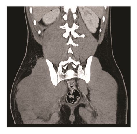 Axial A And Coronal Contrast Enhanced CT B Images Of The Abdomen