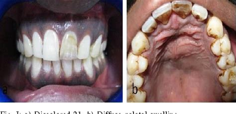 PDF Management Of A Large Periapical Cyst A Case Report Semantic