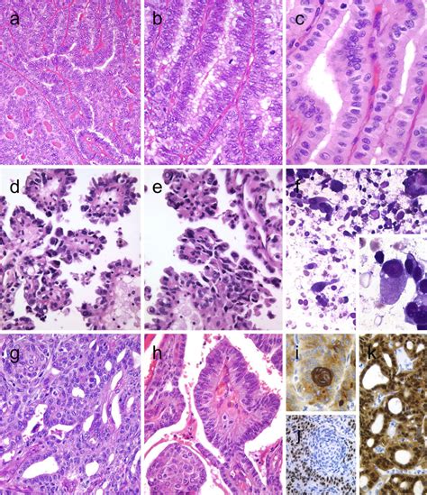 Columnar Cell Variant Of Papillary Thyroid Carcinoma Ptc Showing A