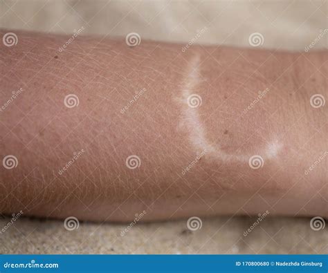 Man Arm And Hand With Keloid Scar Hypertrophic Scar On Skin Royalty