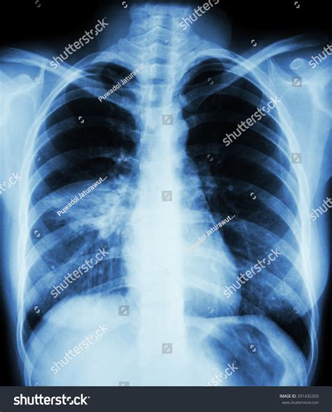 Pneumonia Film Chest Xray Show Alveolar Foto Stock Shutterstock