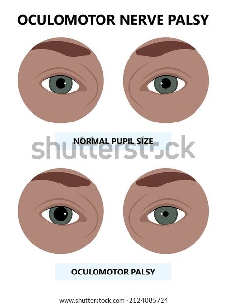 Diplopia Double Vision Test Exam Brain Stock Vector (Royalty Free ...