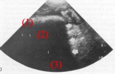 Ultrasound Flashcards Quizlet