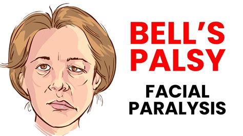 Causes Of Facial Paralysis Bell S Palsy Treatment In Hindi YouTube