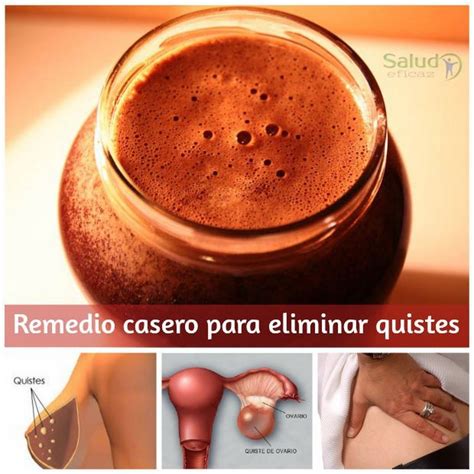 Sint Tico Foto Remedios Naturales Para Eliminar Miomas Y Quistes