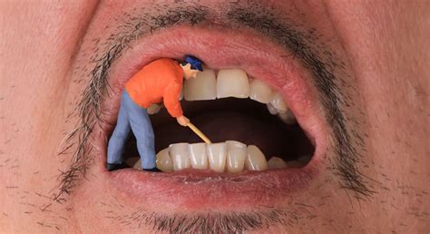 ¿qué Es El Sarro Dental Causas Efectos Y Soluciones
