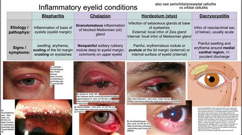 Inflammatory Eyelid Conditions Youtube