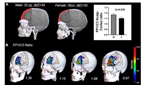 Figure 1 From Sex Gender As A Factor That Influences Transcranial Magnetic Stimulation Treatment