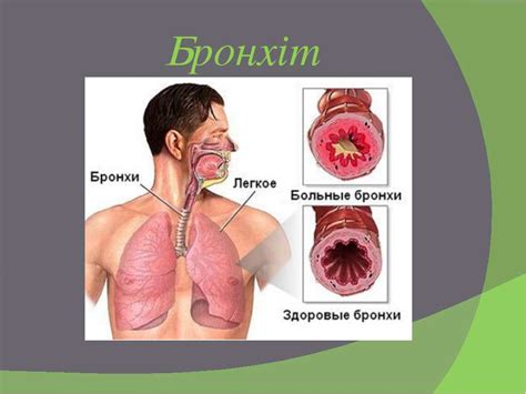 "Бронхіт " - презентація з біології