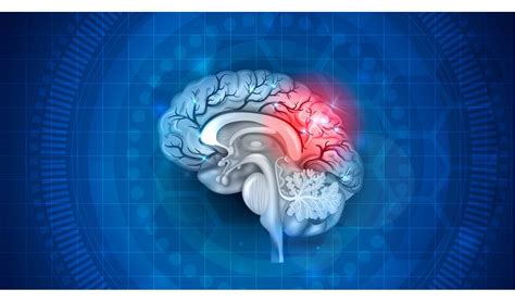 Quais S O Os Sintomas De Um Avc Aprenda A Identific Los E Saiba O Que